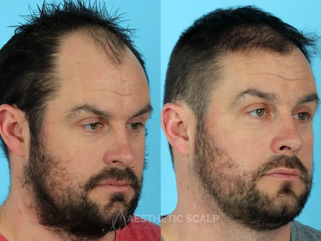 hair restoration before and after photo by aesthetic scalp in chicago il