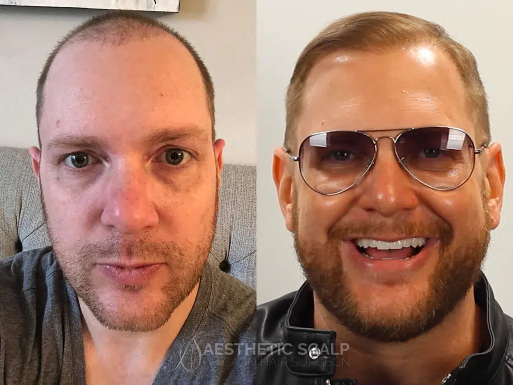 hair restoration before and after photo by aesthetic scalp in chicago il
