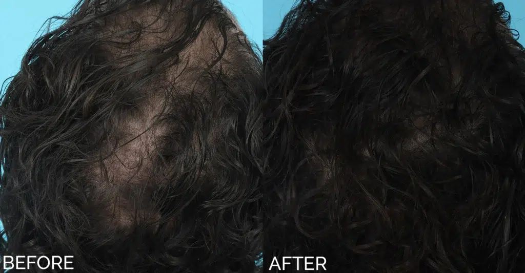 hair restoration before and after photo by aesthetic scalp in chicago il
