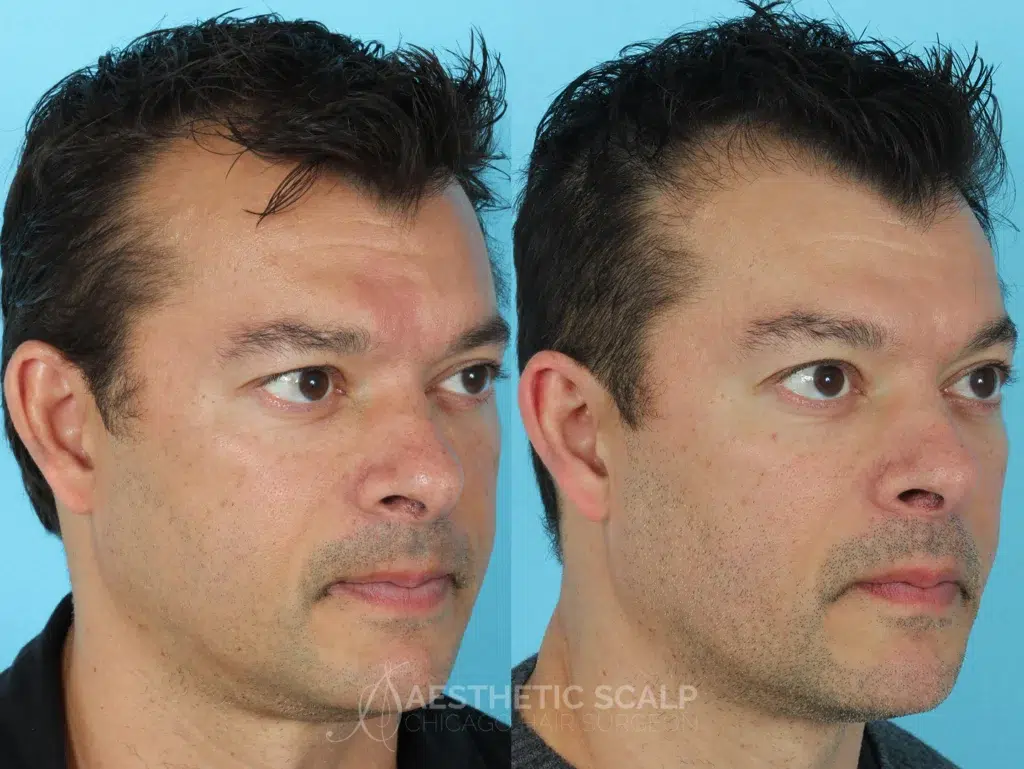 hair restoration before and after photo by aesthetic scalp in chicago il