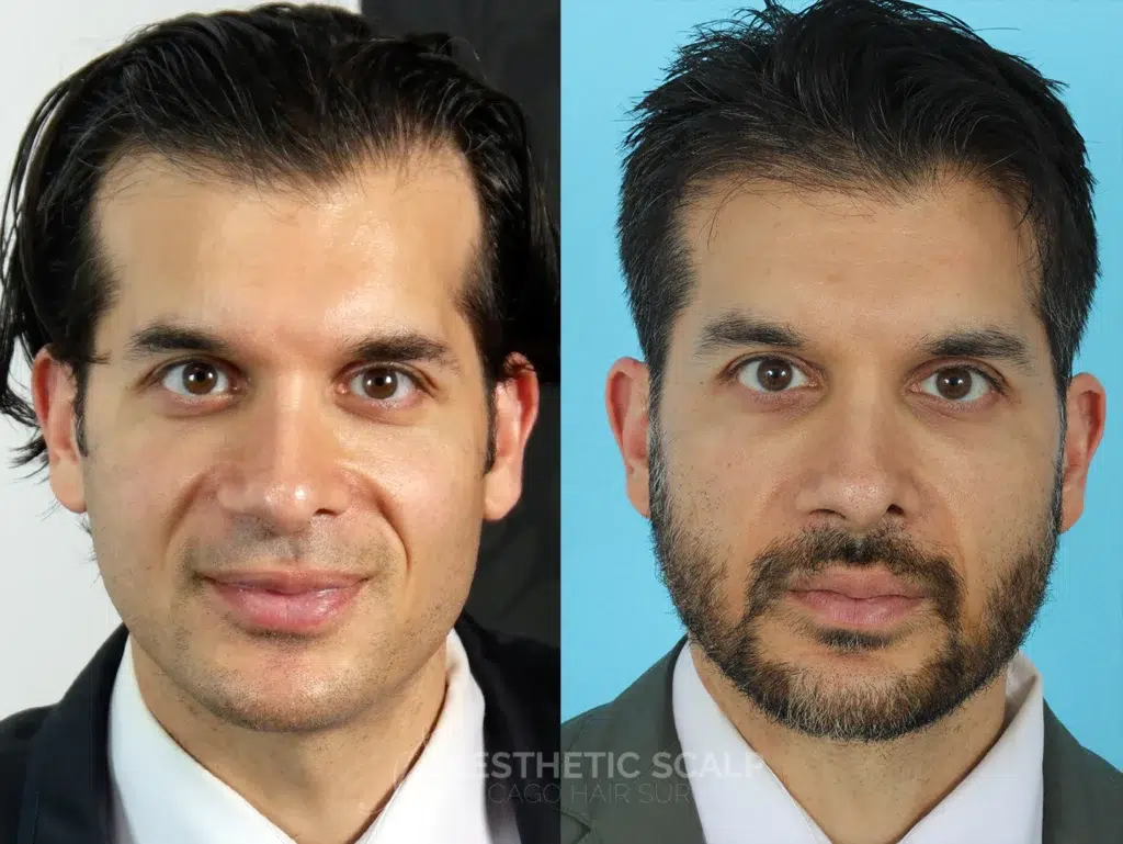hair restoration before and after photo by aesthetic scalp in chicago il