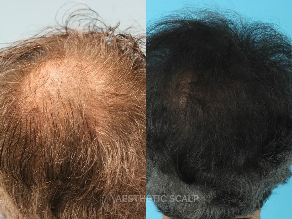 hair restoration before and after photo by aesthetic scalp in chicago il