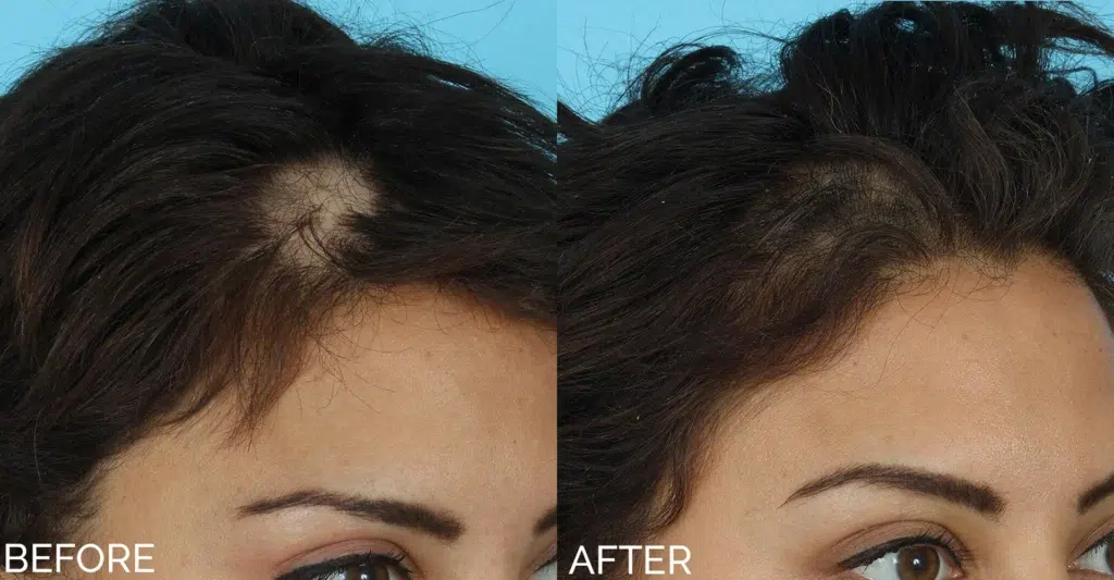 hair restoration before and after photo by aesthetic scalp in chicago il