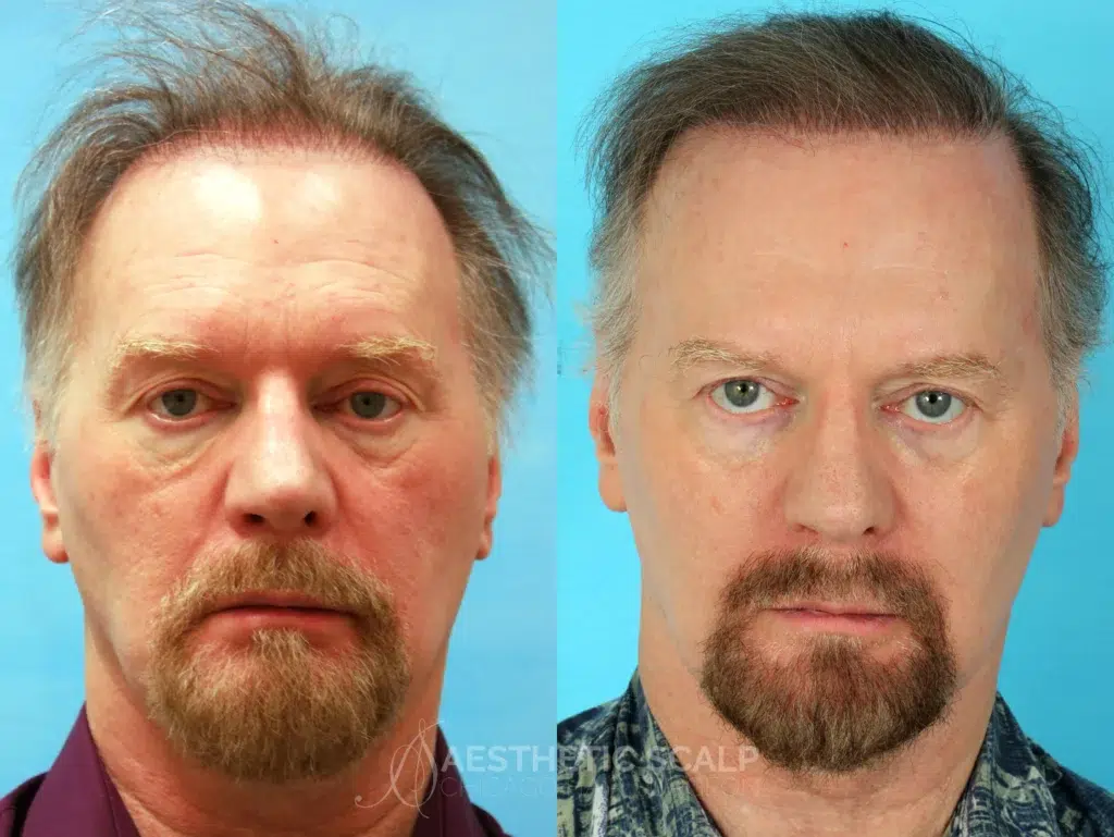 hair restoration before and after photo by aesthetic scalp in chicago il