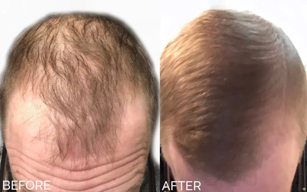 hair restoration before and after photo by aesthetic scalp in chicago il