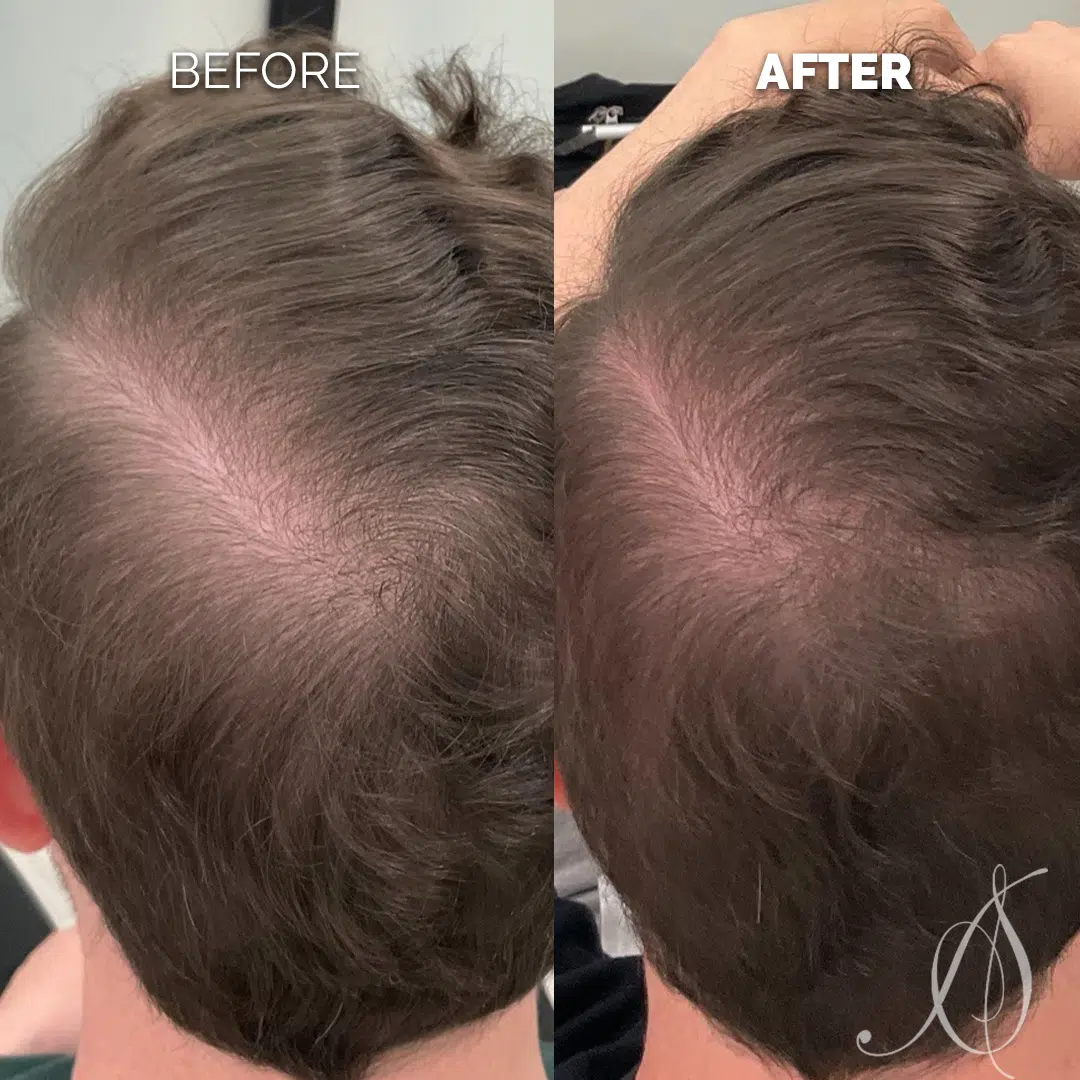 Aesthetic Scalp Chicago Exosomes 14