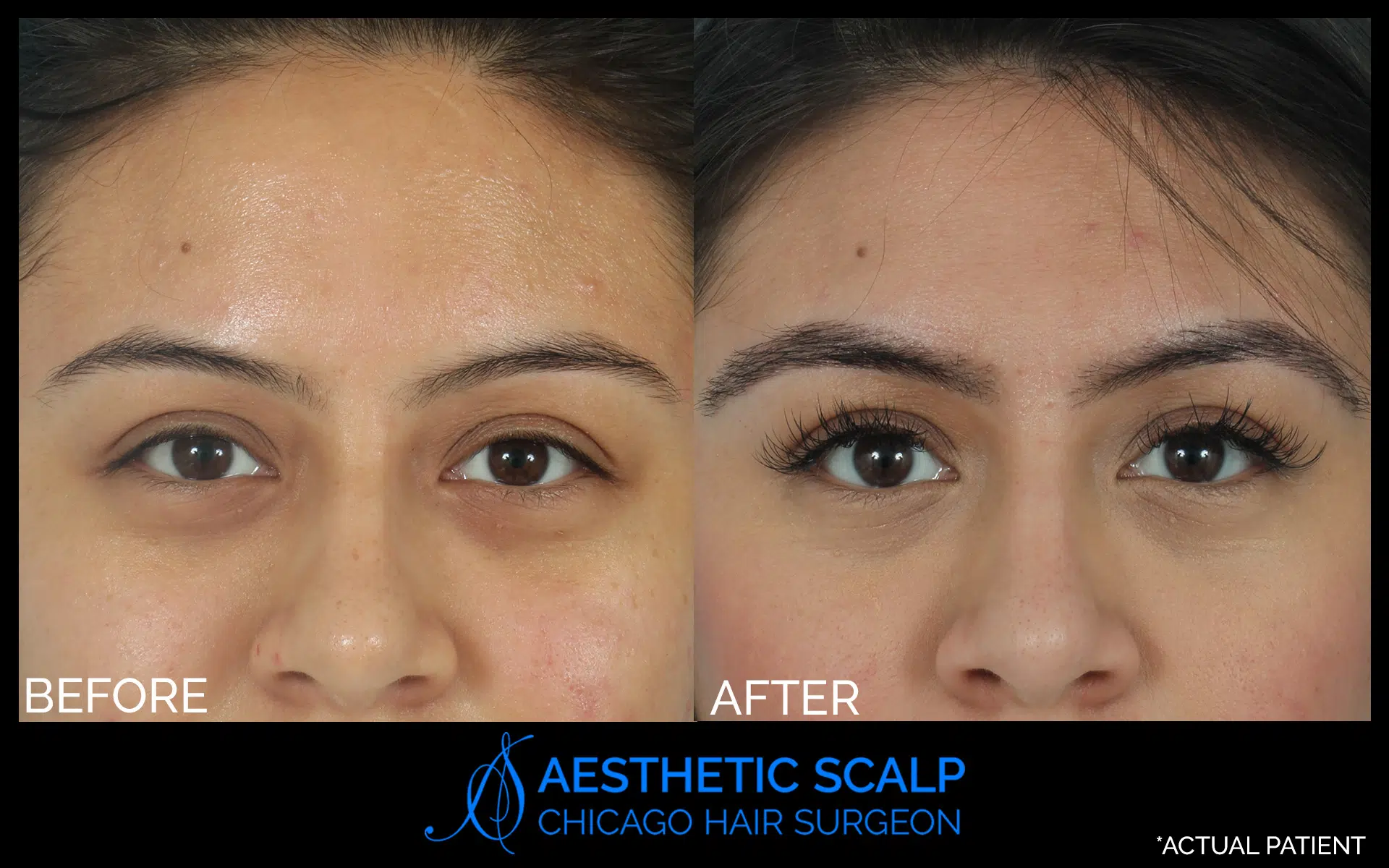 Scalp Brows before and after photo by Aesthetic Scalp