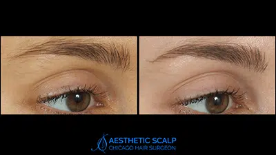 Scalp Brows before and after photo by Aesthetic Scalp
