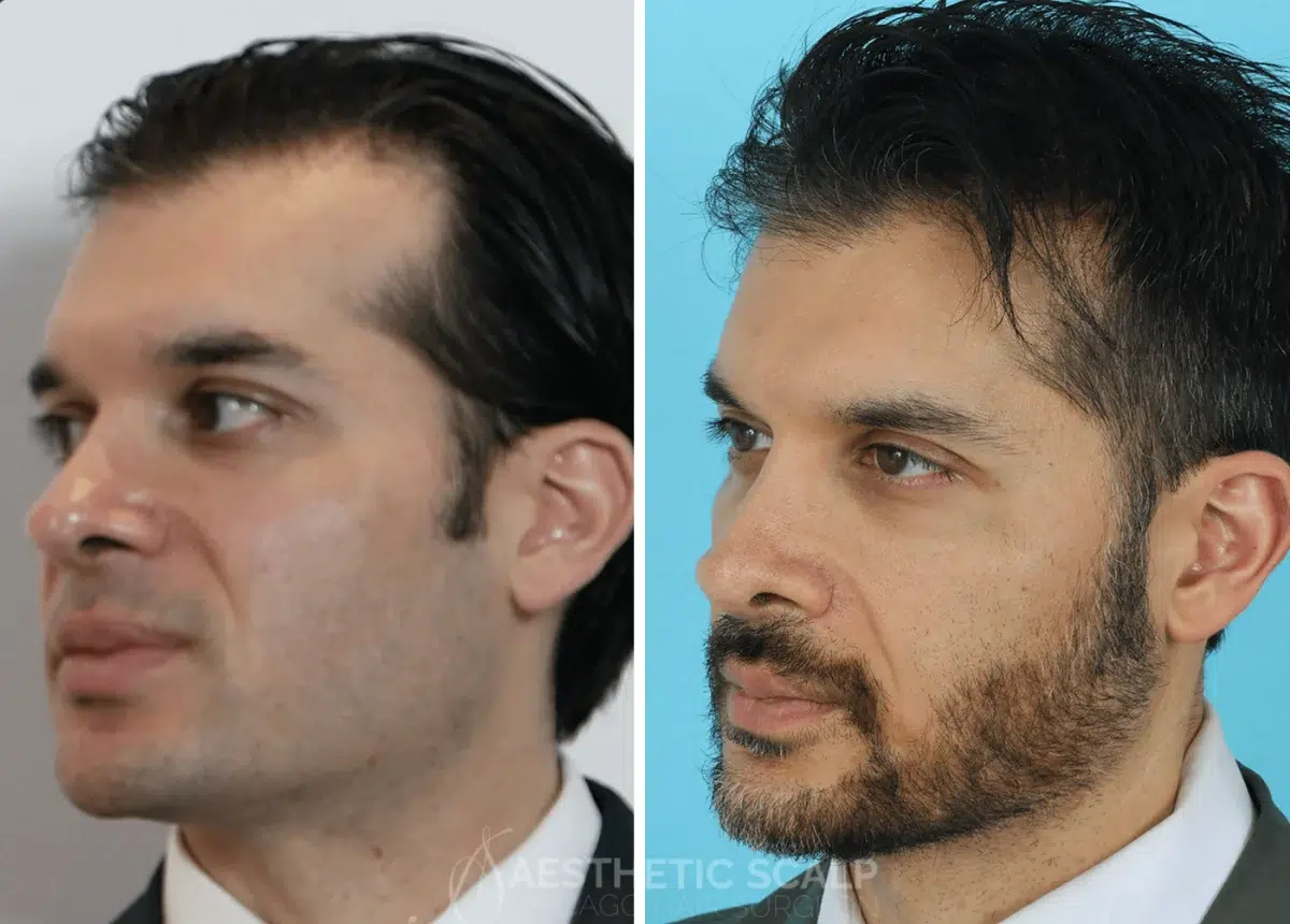 asian hair loss before after by aesthetic scalp chicago hair surgeon