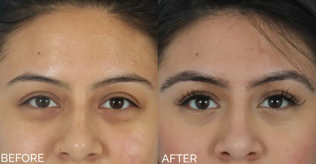 eyebrow transplant before and after