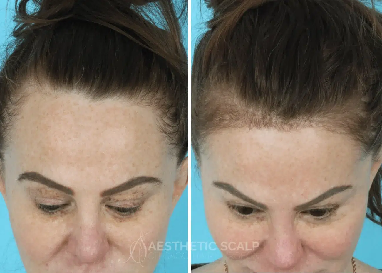female hair loss before after by aesthetic scalp chicago hair surgeon