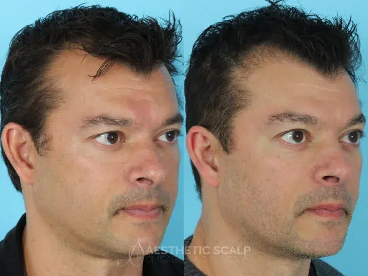 temple hair loss before after by aesthetic scalp chicago hair surgeon