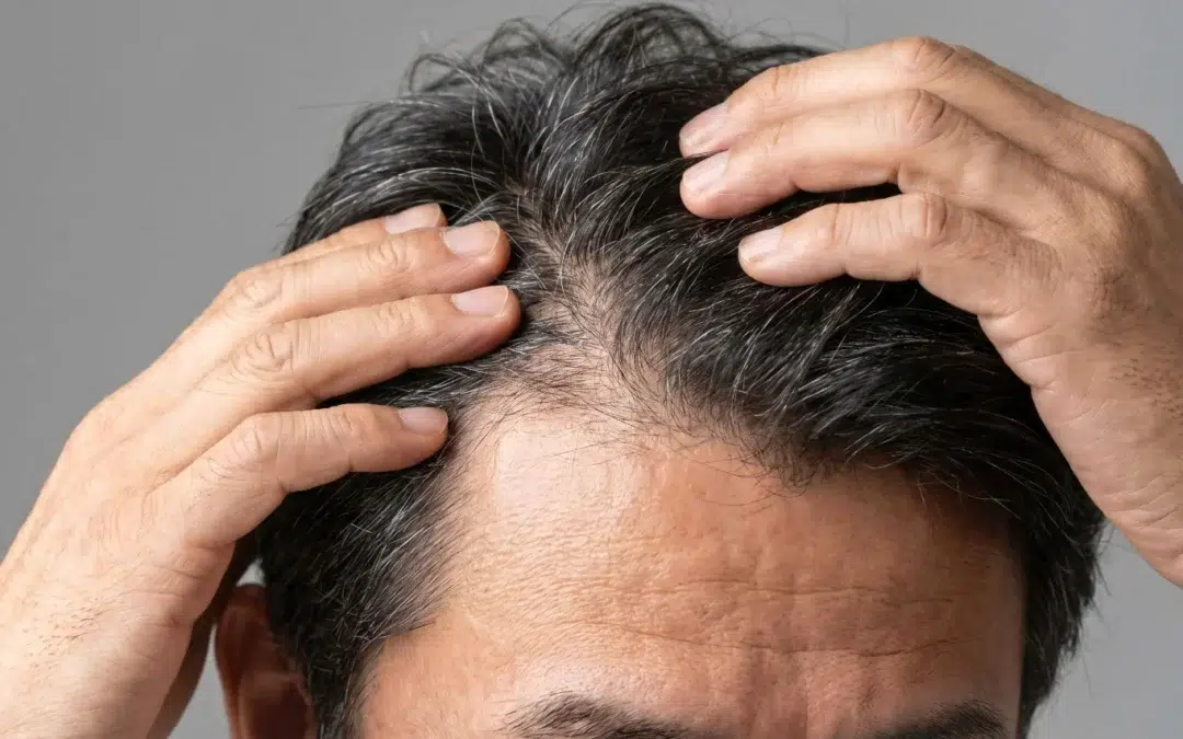 Close up view of a man parting his hair with hands to inspect a thinning hairline and scalp density for hair restoration
